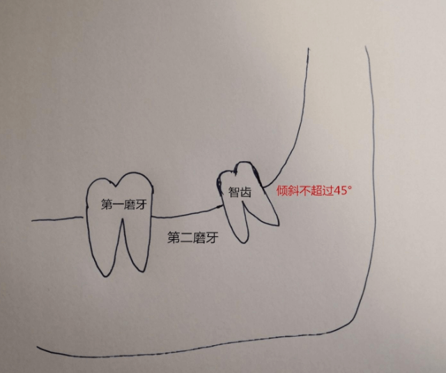 第二磨牙拔了三十年没有补（有些智齿可以不拔，通过正畸或移植保留）
